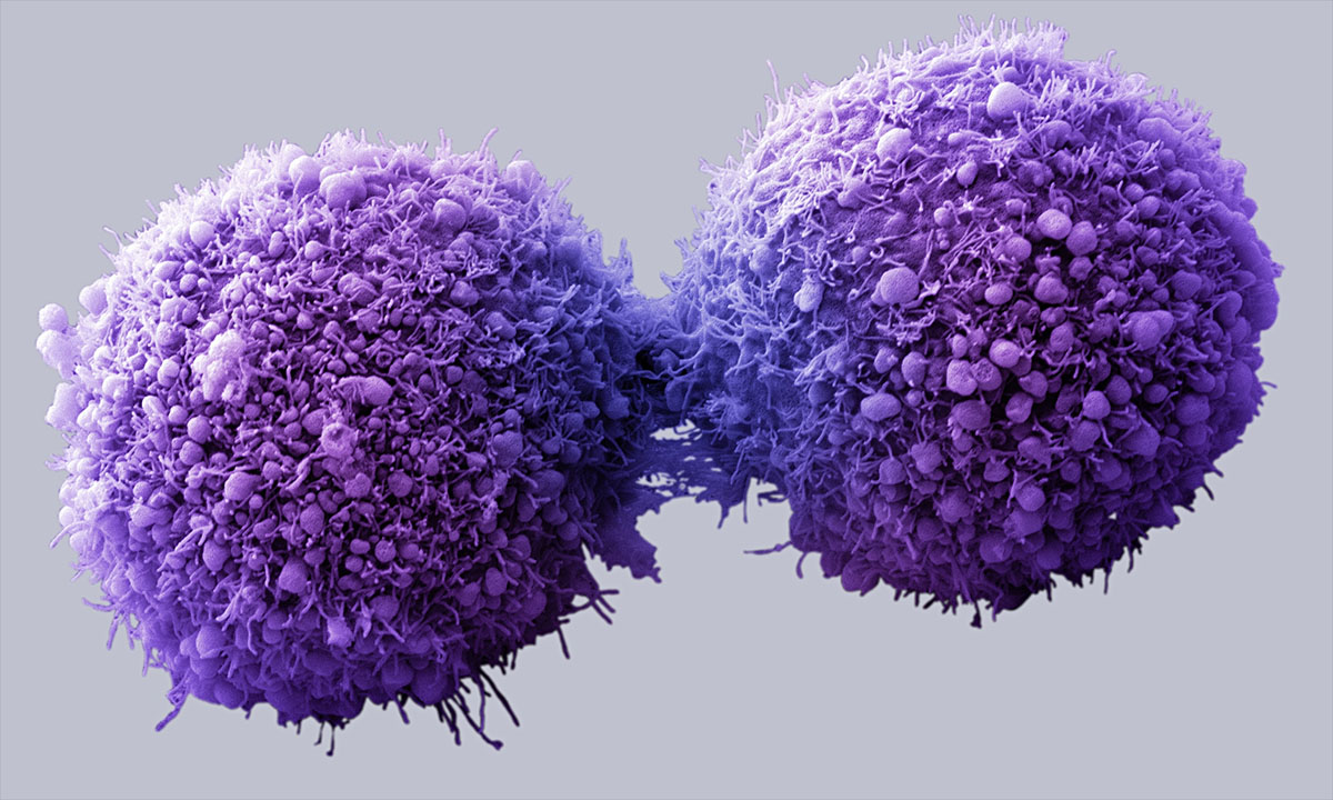pancreatic cancer cells